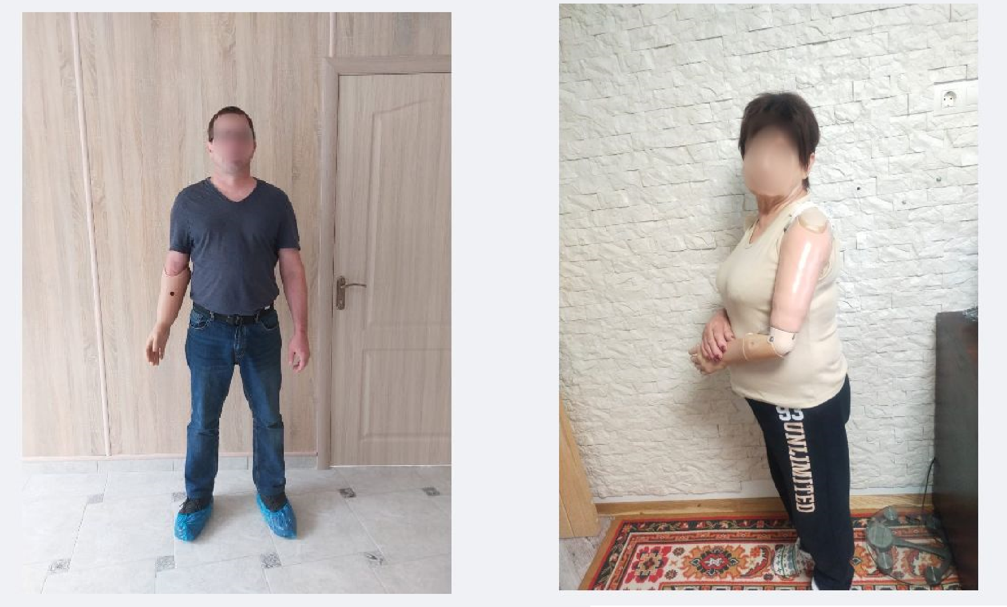 Два жителі Харківщини отримали протези в межах міжнародної співпраці